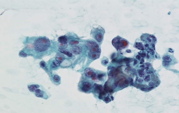 肺癌の細胞（パパニコロウ染色）.jpg