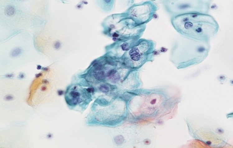 HPV（ヒトパピローマウイルス）が感染した細胞.jpg